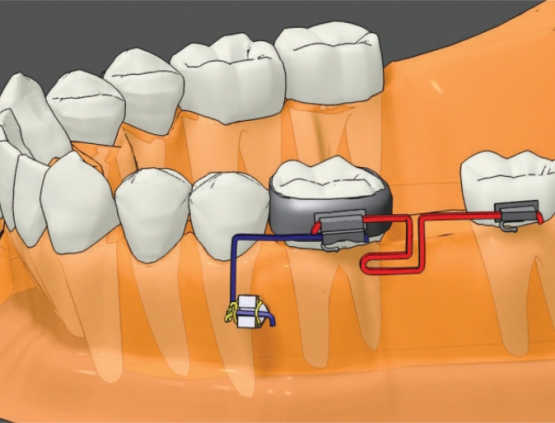 Dentos India: Mini Implants